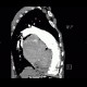 Pulmonary embolism, pulmonary hypertension, cardiomegally, correlation: CT - Computed tomography